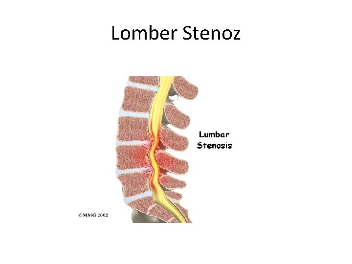 Lomber Stenoz 