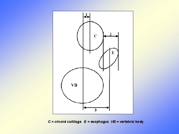 C = cricoid cartilage E = esophagus VB = vertebral body. 