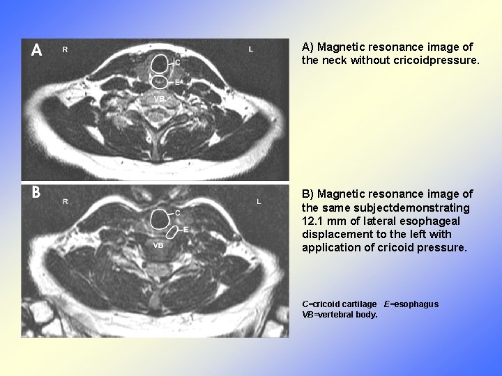 A) Magnetic resonance image of the neck without cricoidpressure. B) Magnetic resonance image of