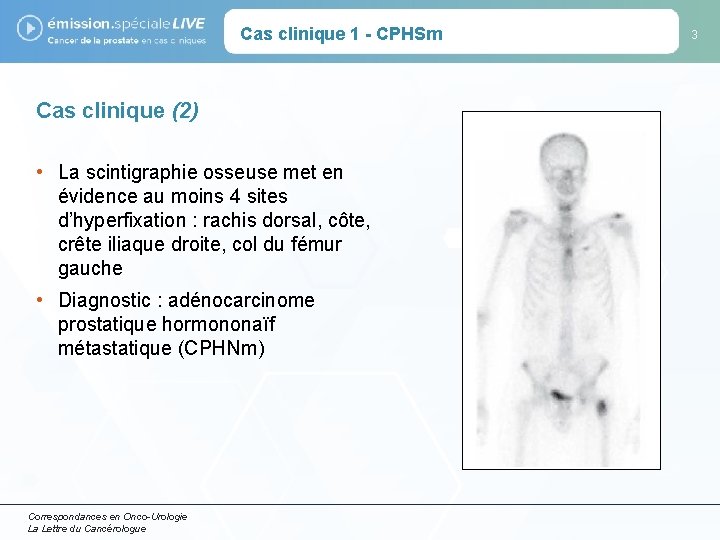 Cas clinique 1 - CPHSm Cas clinique (2) • La scintigraphie osseuse met en