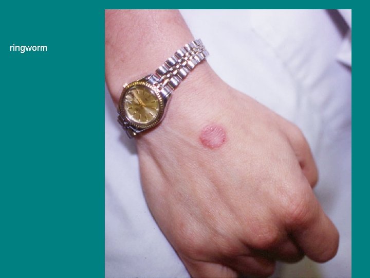 ringworm 
