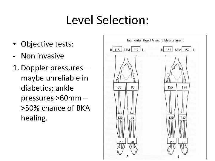 Level Selection: • Objective tests: - Non invasive 1. Doppler pressures – maybe unreliable