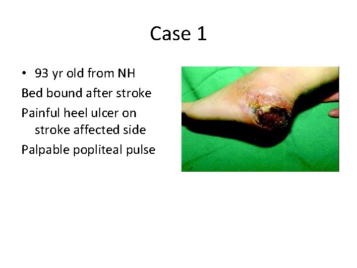 Case 1 • 93 yr old from NH Bed bound after stroke Painful heel