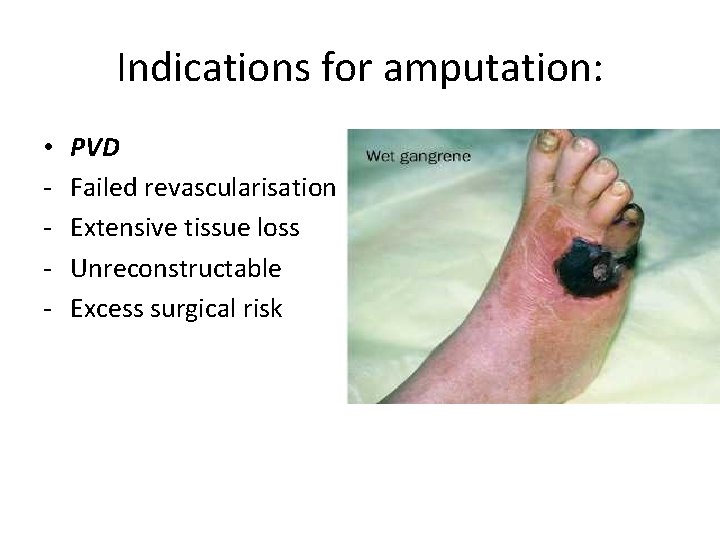 Indications for amputation: • - PVD Failed revascularisation Extensive tissue loss Unreconstructable Excess surgical