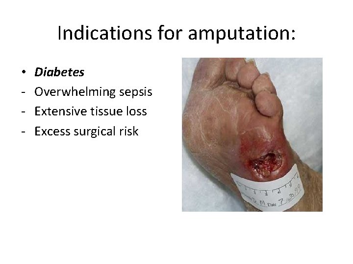 Indications for amputation: • - Diabetes Overwhelming sepsis Extensive tissue loss Excess surgical risk