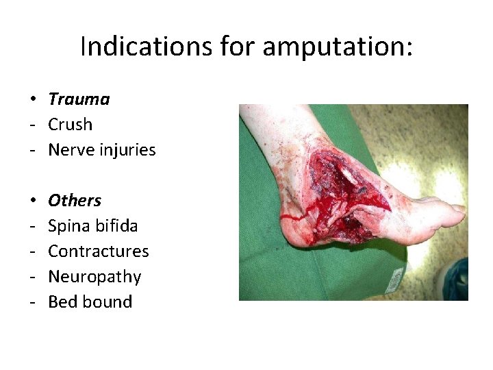 Indications for amputation: • Trauma - Crush - Nerve injuries • - Others Spina
