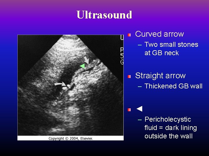 Ultrasound Curved arrow – Two small stones at GB neck ◄ Straight arrow –