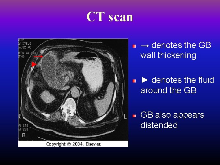 CT scan → → denotes the GB wall thickening ► ► denotes the fluid