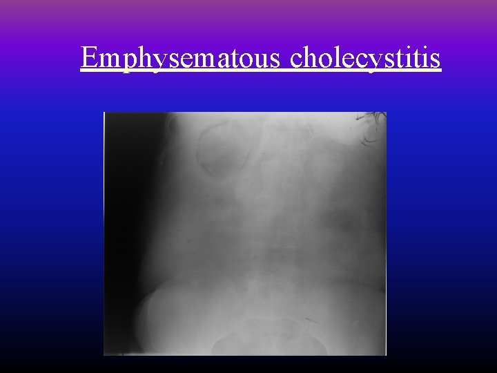 Emphysematous cholecystitis 