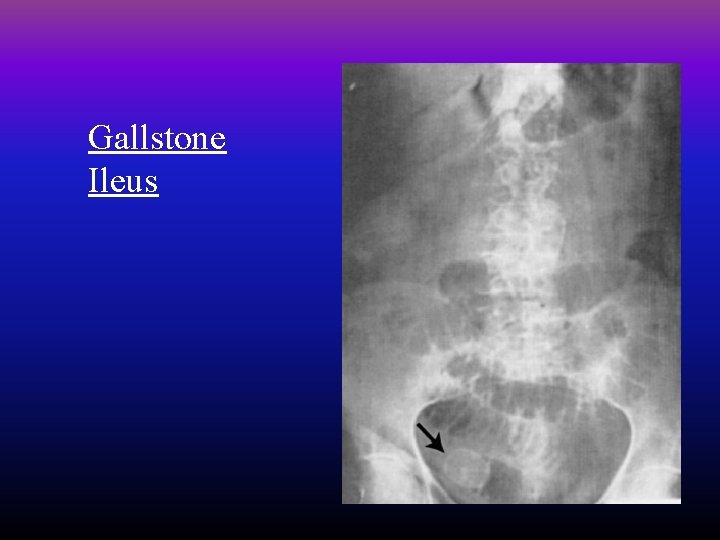 Gallstone Ileus 