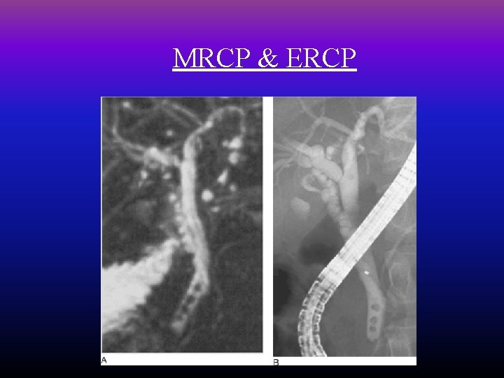 MRCP & ERCP 