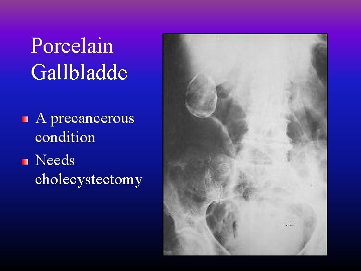 Porcelain Gallbladde A precancerous condition Needs cholecystectomy 