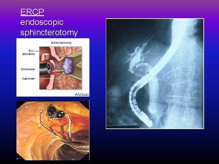 ERCP endoscopic sphincterotomy 