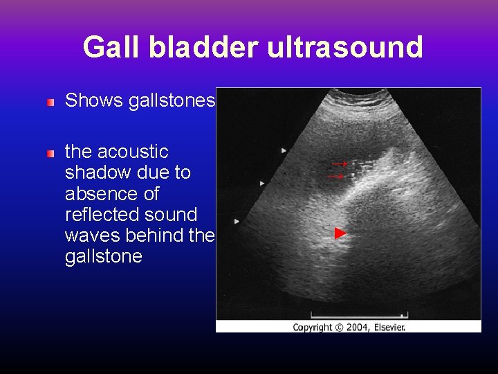 Gall bladder ultrasound Shows gallstones the acoustic shadow due to absence of reflected sound