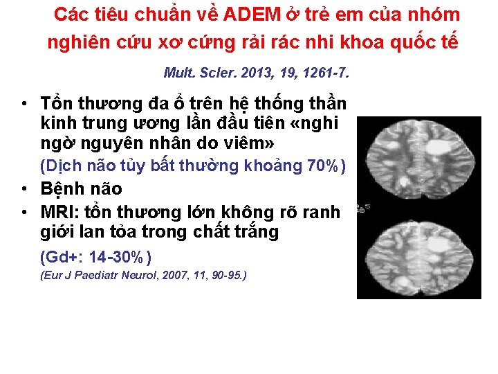 Các tiêu chuẩn về ADEM ở trẻ em của nhóm nghiên cứu xơ cứng