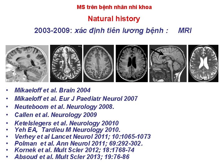  MS trên bệnh nhân nhi khoa Natural history 2003 -2009: xác định tiên
