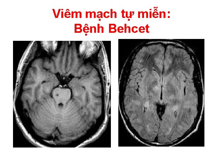 Viêm mạch tự miễn: Bệnh Behcet 
