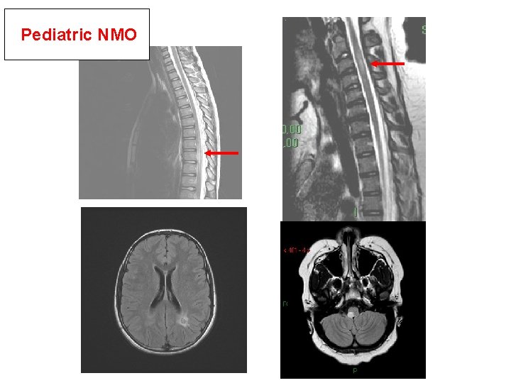  Pediatric NMO 