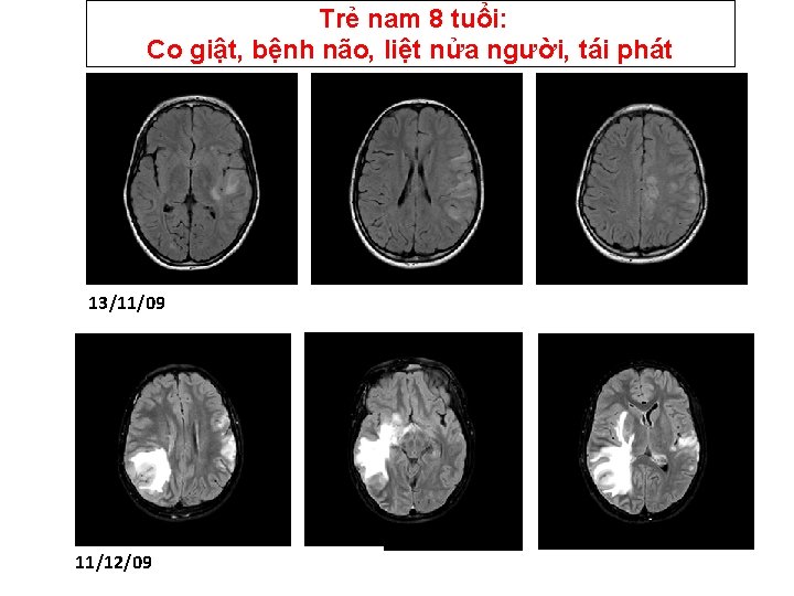  Trẻ nam 8 tuổi: Co giật, bệnh não, liệt nửa người, tái phát