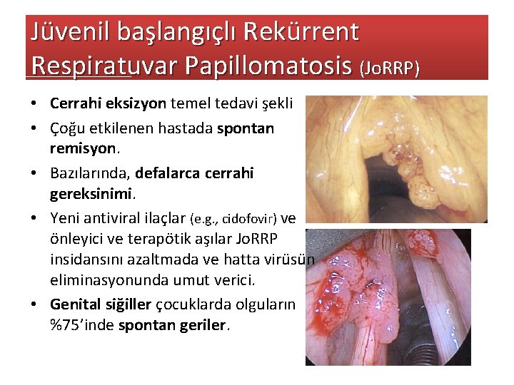Jüvenil başlangıçlı Rekürrent Respiratuvar Papillomatosis (Jo. RRP) • Cerrahi eksizyon temel tedavi şekli •
