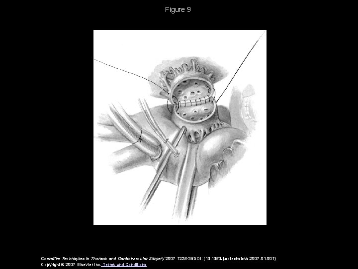 Figure 9 Operative Techniques in Thoracic and Cardiovascular Surgery 2007 1225 -35 DOI: (10.