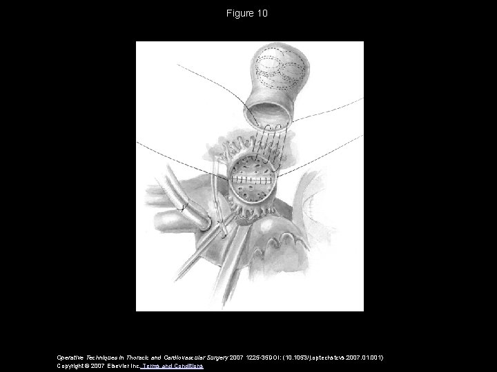 Figure 10 Operative Techniques in Thoracic and Cardiovascular Surgery 2007 1225 -35 DOI: (10.