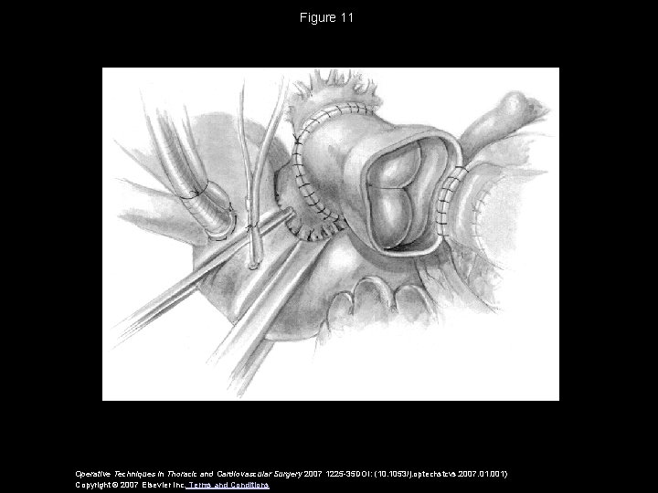 Figure 11 Operative Techniques in Thoracic and Cardiovascular Surgery 2007 1225 -35 DOI: (10.