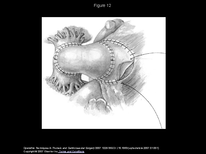 Figure 12 Operative Techniques in Thoracic and Cardiovascular Surgery 2007 1225 -35 DOI: (10.