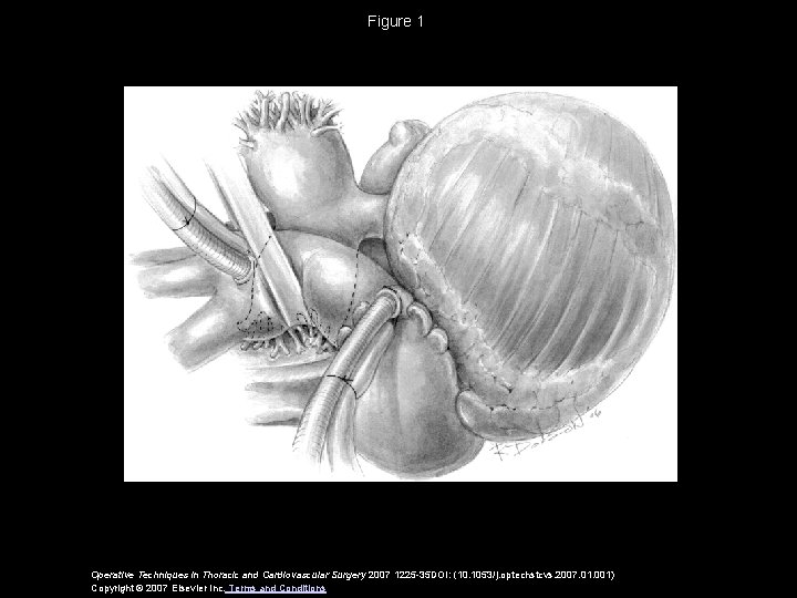 Figure 1 Operative Techniques in Thoracic and Cardiovascular Surgery 2007 1225 -35 DOI: (10.