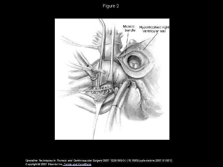 Figure 2 Operative Techniques in Thoracic and Cardiovascular Surgery 2007 1225 -35 DOI: (10.