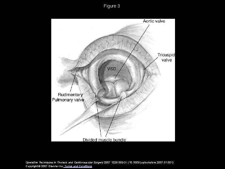Figure 3 Operative Techniques in Thoracic and Cardiovascular Surgery 2007 1225 -35 DOI: (10.