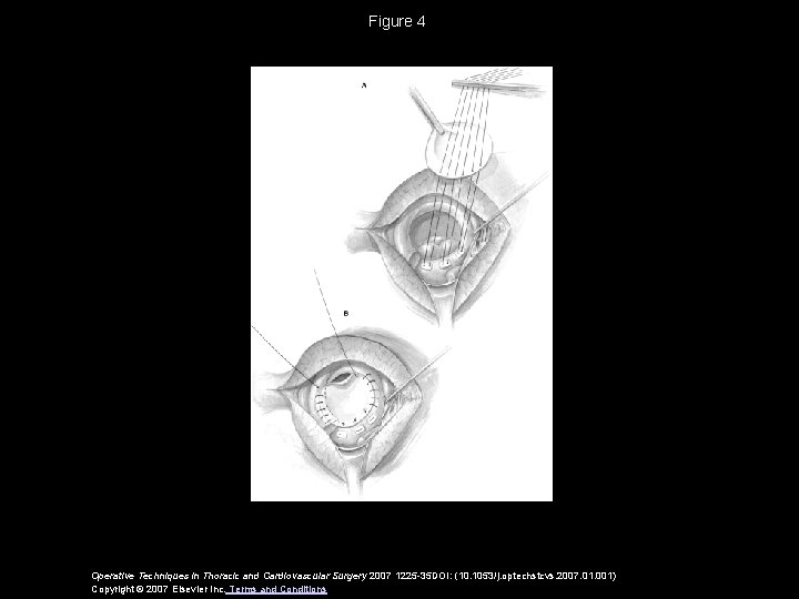 Figure 4 Operative Techniques in Thoracic and Cardiovascular Surgery 2007 1225 -35 DOI: (10.