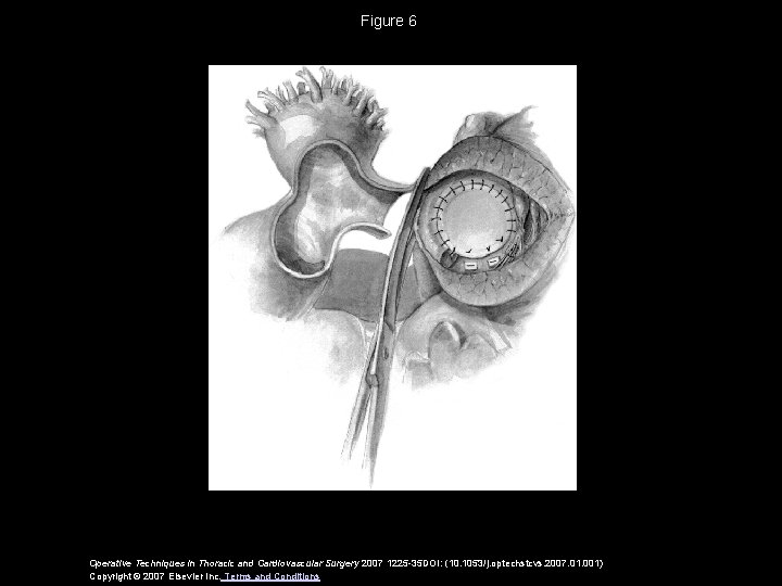 Figure 6 Operative Techniques in Thoracic and Cardiovascular Surgery 2007 1225 -35 DOI: (10.