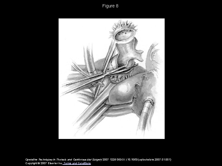 Figure 8 Operative Techniques in Thoracic and Cardiovascular Surgery 2007 1225 -35 DOI: (10.