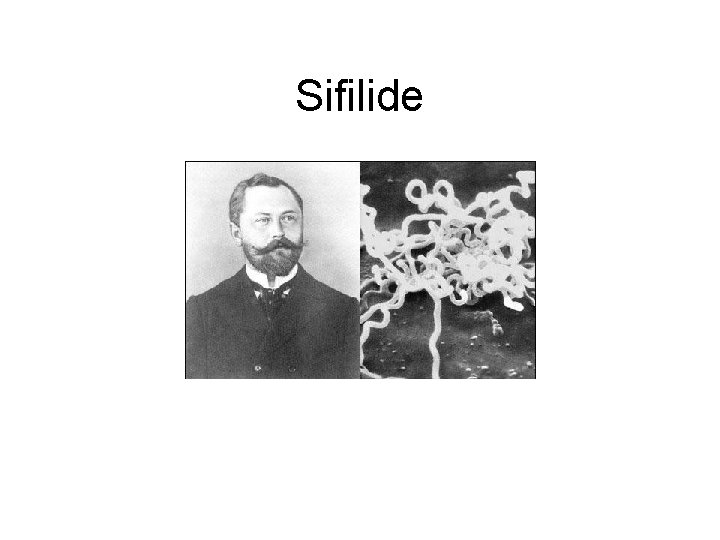 Sifilide 