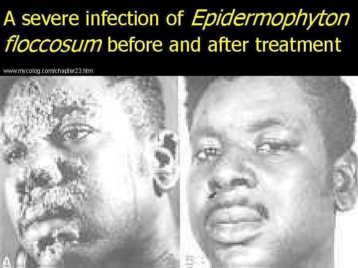 A severe infection of Epidermophyton floccosum before and after treatment www. mycolog. com/chapter 23.
