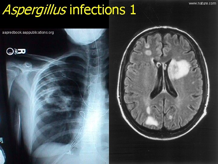 Aspergillus infections 1 aapredbook. aappublications. org www. nature. com 