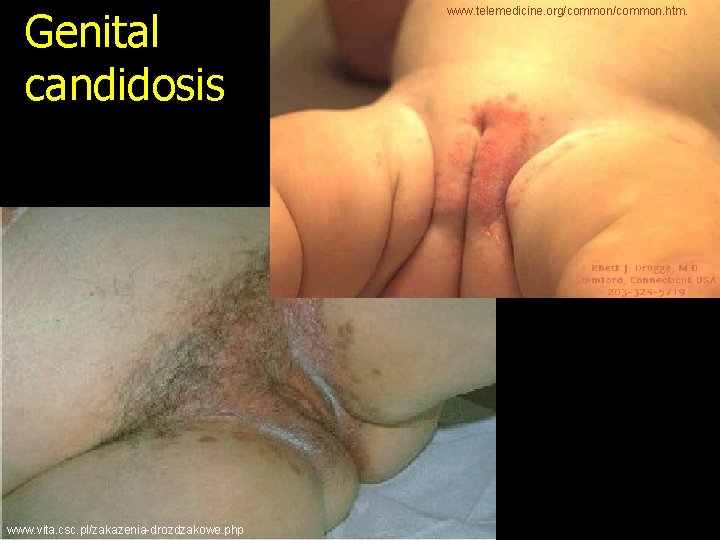 Genital candidosis www. vita. csc. pl/zakazenia-drozdzakowe. php www. telemedicine. org/common. htm. 