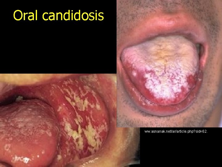 Oral candidosis ww. asnanak. net/ar/article. php? sid=62. 