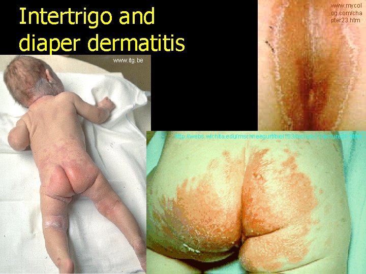 Intertrigo and diaper dermatitis www. mycol og. com/cha pter 23. htm www. itg. be