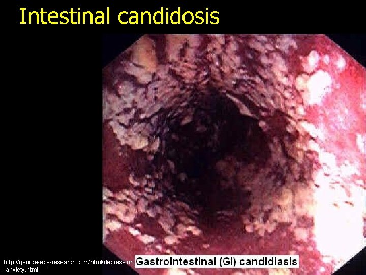 Intestinal candidosis http: //george-eby-research. com/html/depression -anxiety. html 