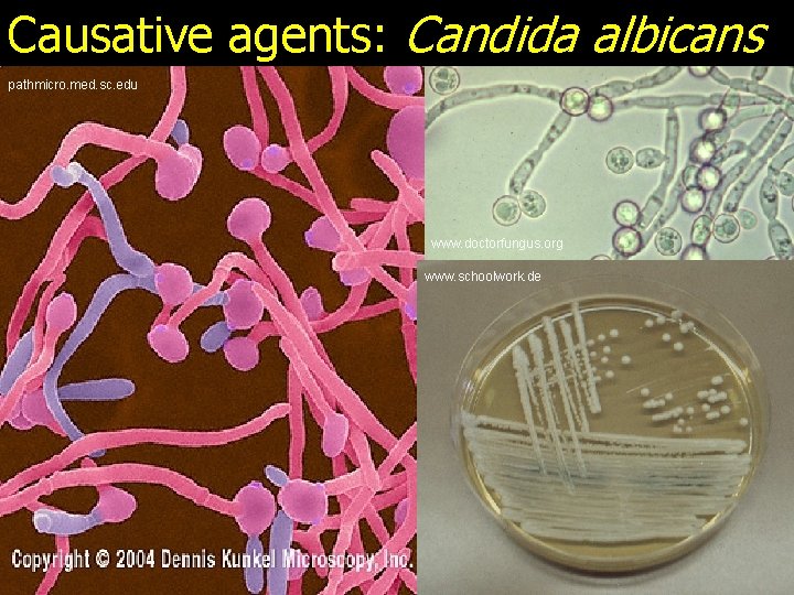 Causative agents: Candida albicans pathmicro. med. sc. edu www. doctorfungus. org www. schoolwork. de