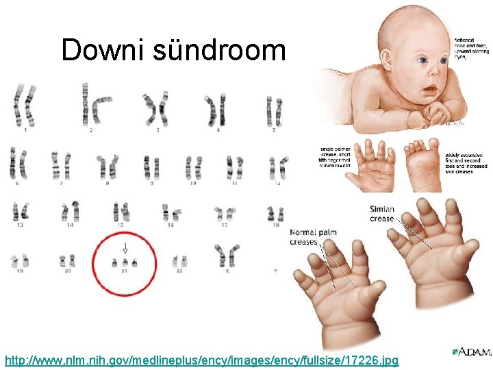 Downi sündroom http: //www. nlm. nih. gov/medlineplus/ency/images/ency/fullsize/17226. jpg 