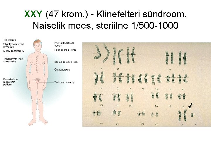 XXY (47 krom. ) - Klinefelteri sündroom. Naiselik mees, steriilne 1/500 -1000 