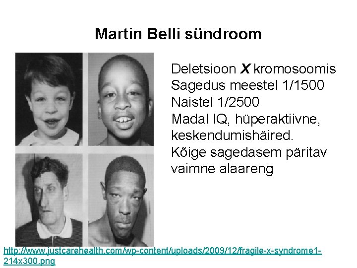 Martin Belli sündroom Deletsioon X kromosoomis Sagedus meestel 1/1500 Naistel 1/2500 Madal IQ, hüperaktiivne,