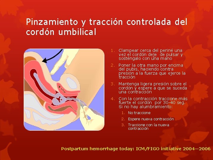 Pinzamiento y tracción controlada del cordón umbilical 1. Clampear cerca del periné una vez