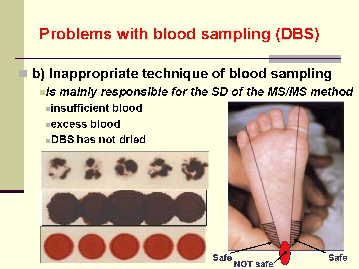 Problems with blood sampling (DBS) n b) Inappropriate technique of blood sampling nis mainly