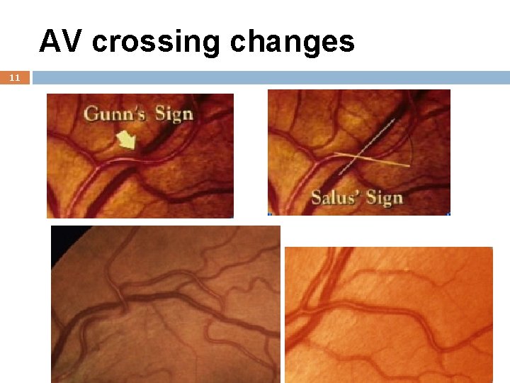 AV crossing changes 11 