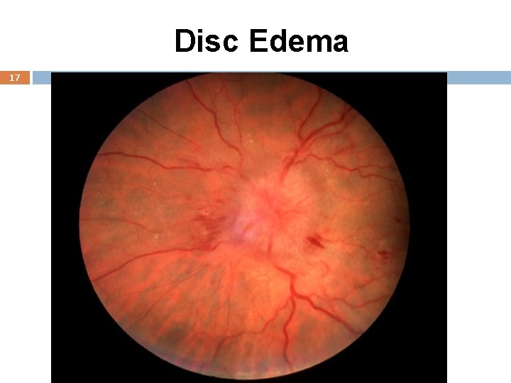Disc Edema 17 