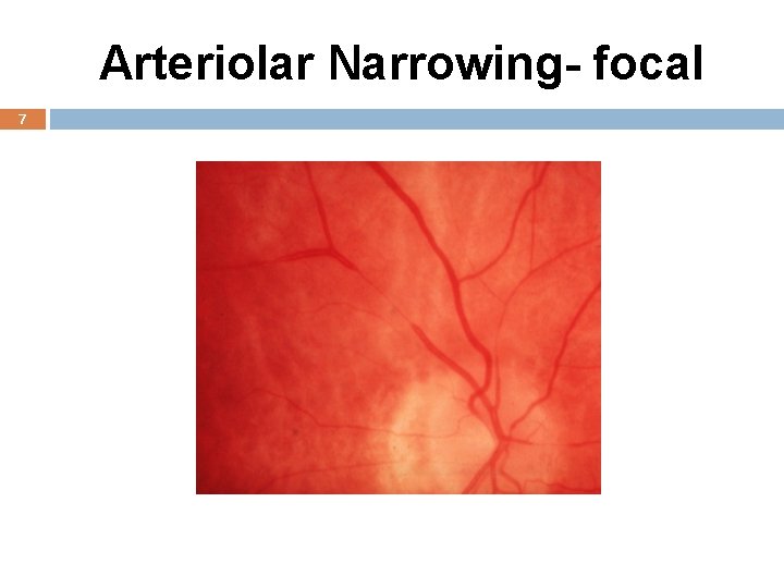 Arteriolar Narrowing- focal 7 